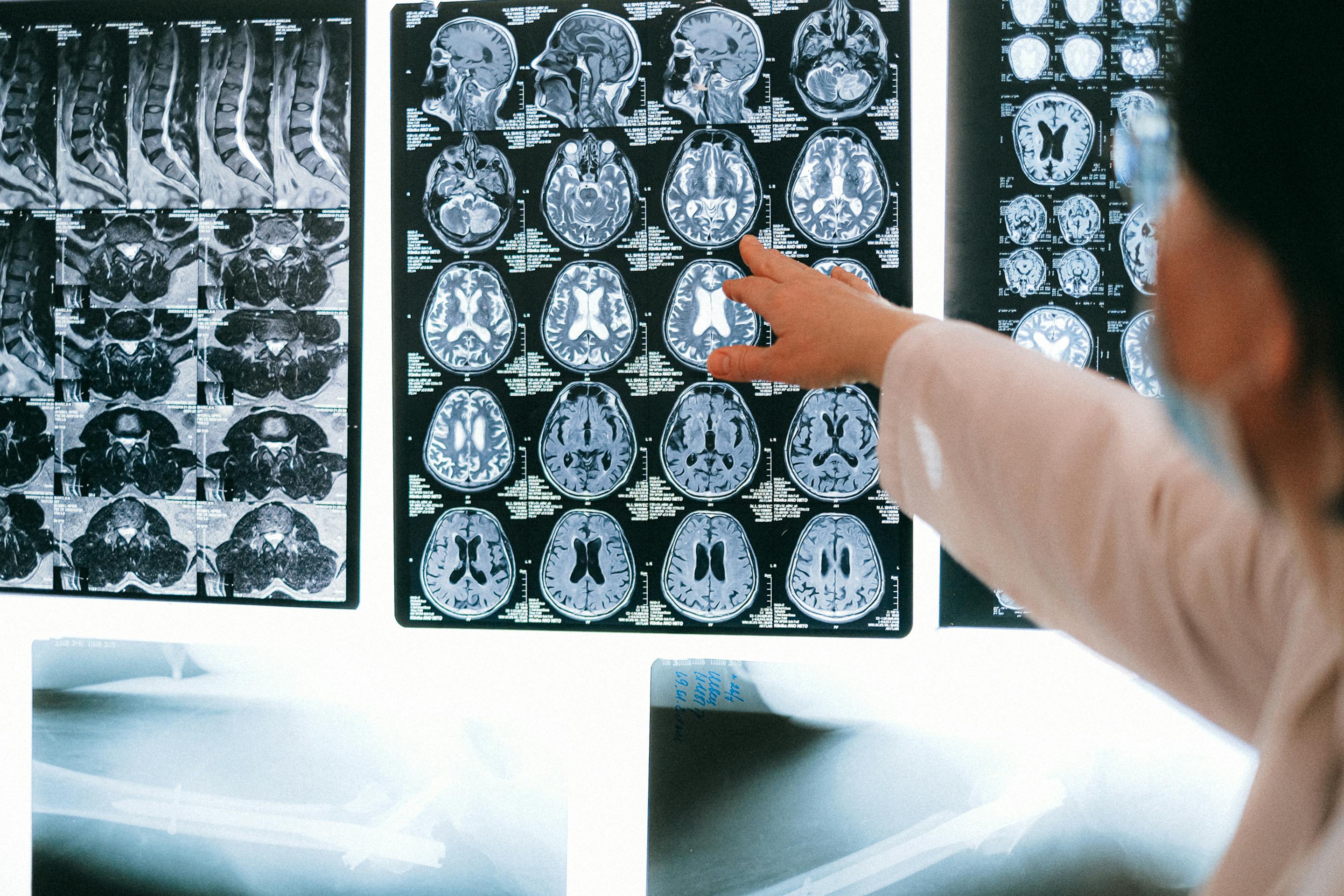 Ressonância magnética cerebral