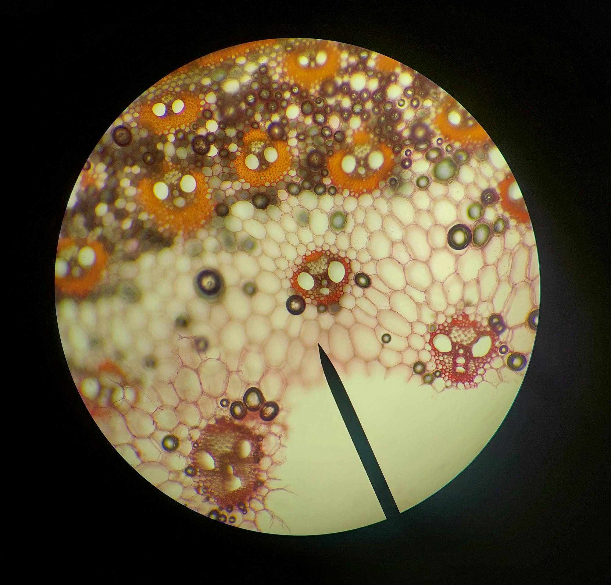 Microscopia de células — atrofia vilositária celíaca